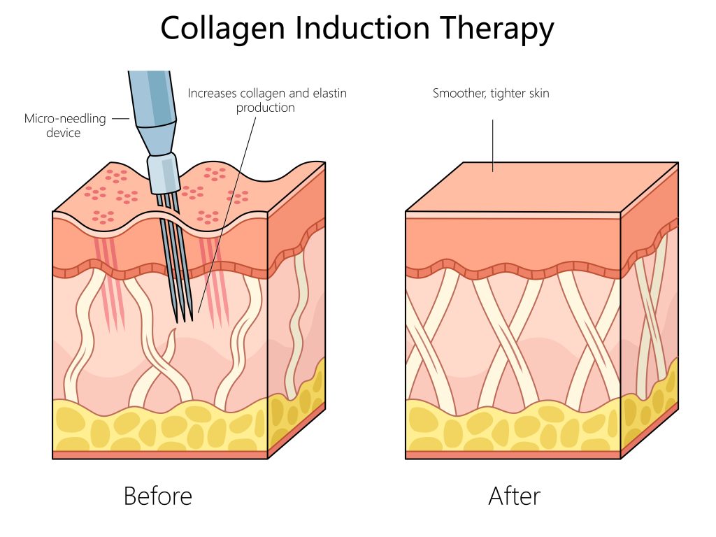 Collagen Induction Therapy Before After Diagram
