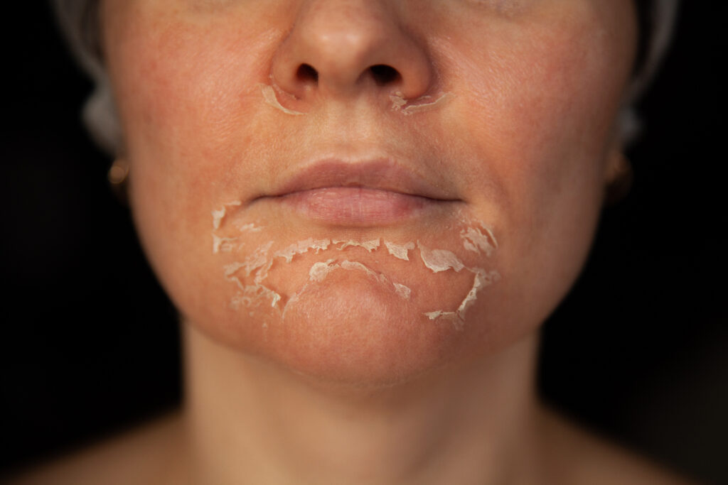 Peeling skin on the face. Woman's face after chemical peeling. Exfoliation of old skin.